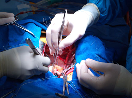 Open Heart Surgery Unit